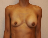Feel Beautiful - Breast Revision San Diego 3 - Before Photo